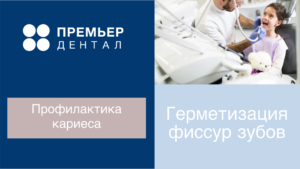 Герметизация фиссур зубов