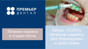 лечение зубов без бормашины тюмень