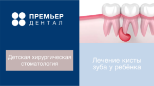 лечение кисты зуба у ребенка