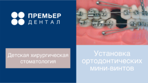 установка ортодонтических мини-винтов